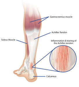 Achilles Tendonitis – ICB Medical