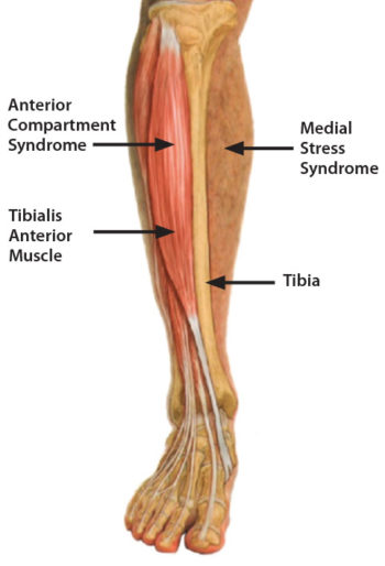 Shin Splints – ICB Medical